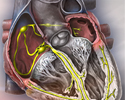 Atrial fibrillation - Animation
                    