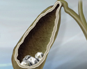 Gallstones - Animation
                    