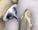 Hip joint replacement - Animation
                    