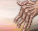 Rheumatoid arthritis - Animation
                    