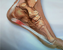 Plantar fasciitis - Animation
                    