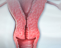 Cervical cancer - Animation
                    