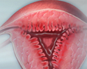 Endometriosis - Animation
                    