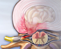 Herniated disk - Animation
                    