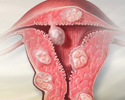 Uterine fibroids - Animation
                    