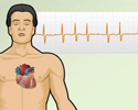 Cardiac arrhythmia symptoms - Animation
                        