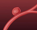 Aneurysm description - Animation
                        