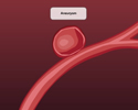 Aortic aneurysm description - Animation
                        