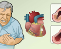 Angina causes and symptoms - Animation
                        