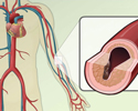 Atherosclerosis causes - Animation
                        