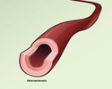 Atherosclerosis overview - Animation
                        