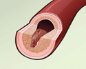 Cardiac and vascular disorders: Blood clot - Animation
                        