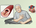 Coronary artery disease (CAD) overview - Animation
                        