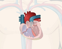 Congenital heart defects - CHD - blood flow defects
