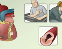 Angina pectoris treatment - Animation
                        