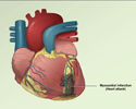Heart attack (myocardial infarction) overview