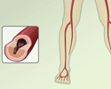 Peripheral artery disease  (PAD) - overview - Animation
                        