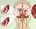 Stroke - Description, causes, risks and treatment - Animation
                        