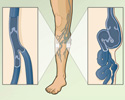 Varicose veins overview - Animation
                        