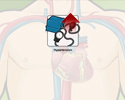 Heart disease modifiable risk factors -  hypertension - Animation
                        