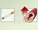 Heart disease modifiable risk factors - smoking