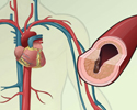 Cardiovascular disease  - description - Animation
                        