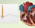 Electrocardiogram - ECG - what the tracing tells your doctor - Animation
                        