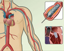 Cardiac catheterization - angioplasty and other procedures 
