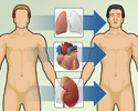 Heart transplant - overview