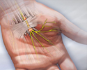 Carpal tunnel syndrome - Animation
                    
