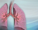 Chronic obstructive pulmonary disease - Animation
                    