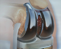Knee joint replacement - Animation
                    