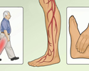 Diabetes and risk of serious foot or leg problems - Animation
                        