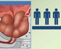 Benign prostatic hyperplasia (BPH) cause and symptoms - Animation
                        