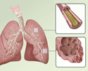 Overview of chronic obstructive pulmonary disease (COPD) - Animation
                        