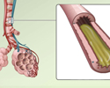 Your lungs: The inflammatory response - Animation
                        