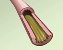 The inflammatory response: Symptoms and causes of airflow limitation - Animation
                        