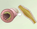 What happens when a person has cystic fibrosis (CF)? - Animation
                        