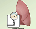 Symptoms of pulmonary hypertension - Animation
                        