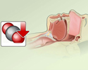 Central sleep apnea - Animation
                        