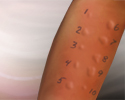 Allergies - Animation
                    