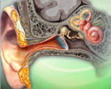 Hearing loss - Animation
                    