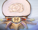 Spinal stenosis - Animation
                    