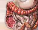 Colon cancer - Animation
                    