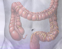 Colon cancer screening - Animation
                    