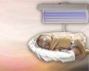 Newborn jaundice - Animation
                                      