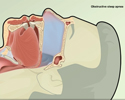 What is obstructive sleep apnea (OSA)? - Animation                        