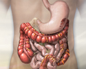 Ulcerative colitis - Animation                    