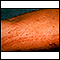 Poison oak rash on the arm