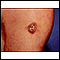 Sarcoma de Kaposi - lesión en la piel